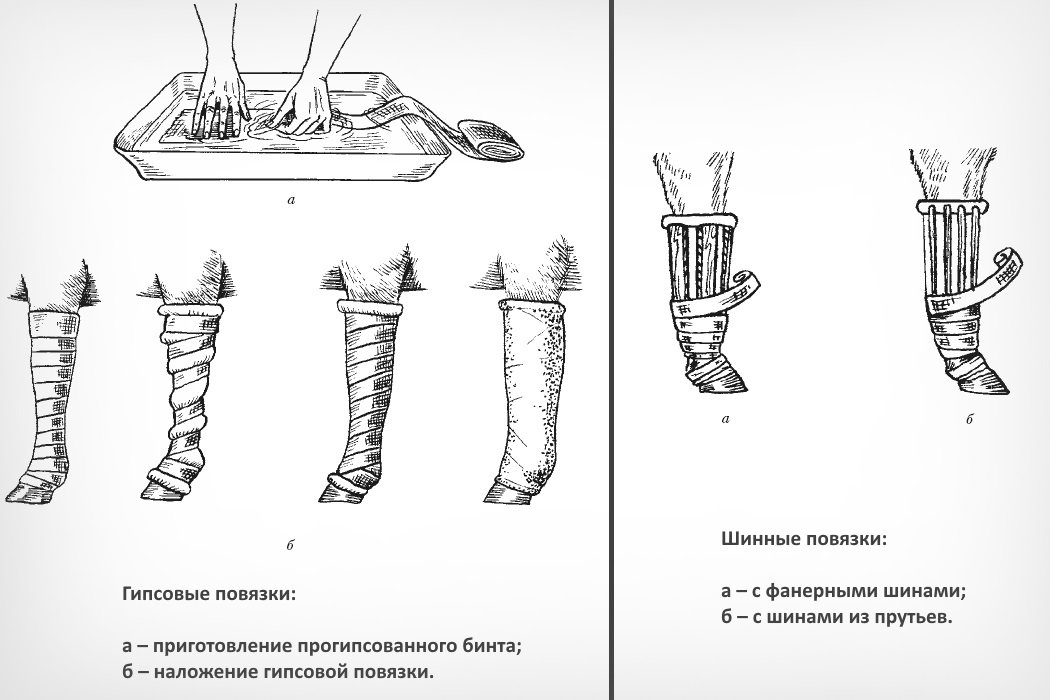 Наложение гипса при переломе конечности